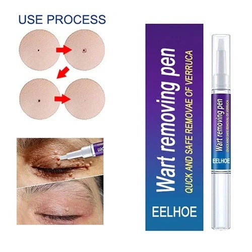 Warts & Moles Remover Pen (14 Days Money Back Guarantee)