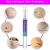 Warts & Moles Remover Pen (14 Days Money Back Guarantee)