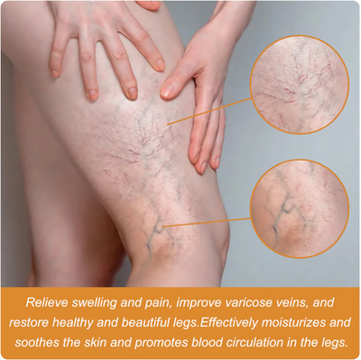 Turmeric Varicose Veins Relief Spray